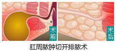 肛周脓肿切开排脓术