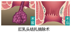肛乳头结扎摘除术