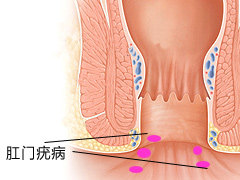 肛门疣病是什么病