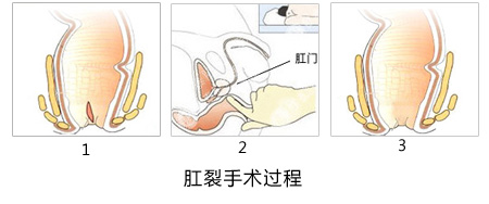 肛裂的手术过程