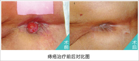 痔疮手术图片