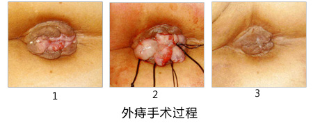 外痔疮的手术过程