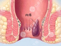 痔疮图片什么样