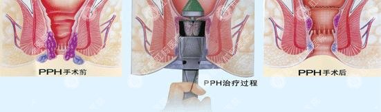 肛泰智能肛泰方法肛肠吻合器