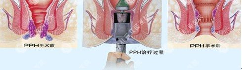 肛肠吻合器手术过程示意图